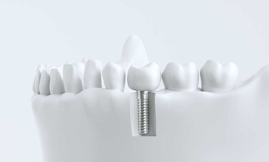 Implantologie - Praxis für Zahnheilkunde Dr. Maximilian Grimm und Zahnärztin Eva Krieger
